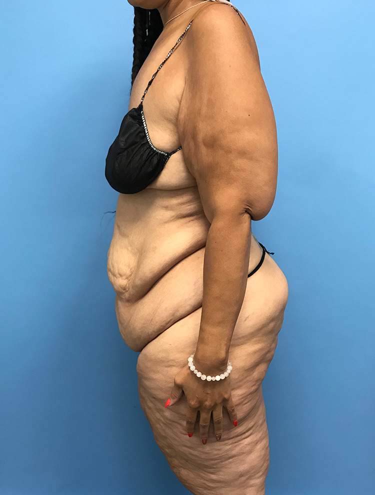 Side view of a female patient before tummy tuck surgery showing excess abdominal skin and volume