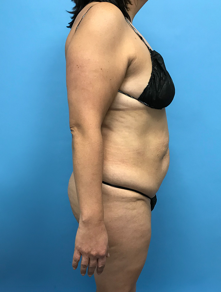 Side profile of a patient before tummy tuck surgery, highlighting abdominal area with excess skin and fatty tissue.