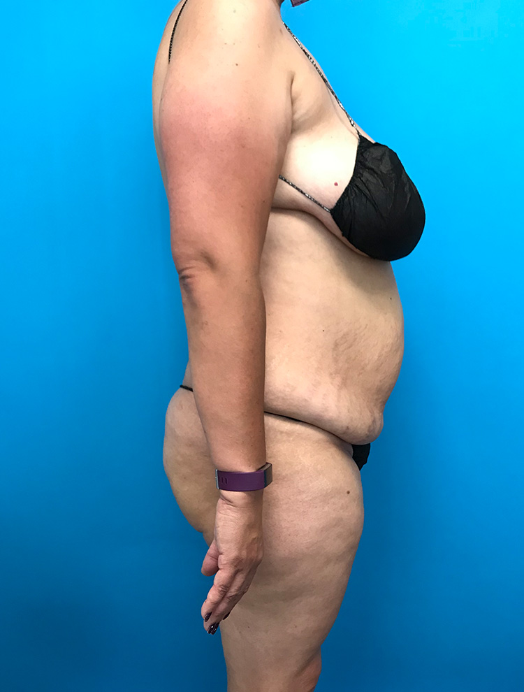 Side view of a woman's abdomen before tummy tuck surgery, highlighting excess skin and fat around the midsection.