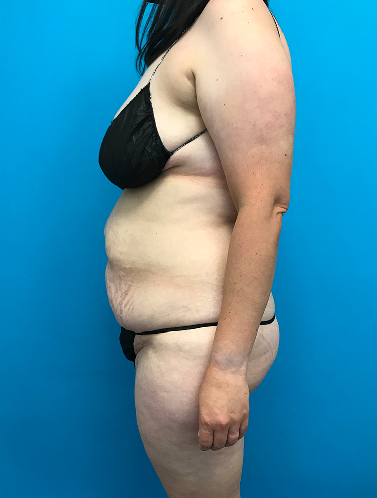 Side view of a woman's abdomen before tummy tuck surgery.