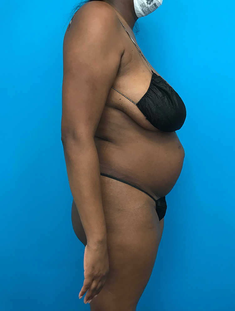 A woman shown from the side before a tummy tuck procedure, wearing black lingerie. The image highlights her abdominal area and body shape before surgery.