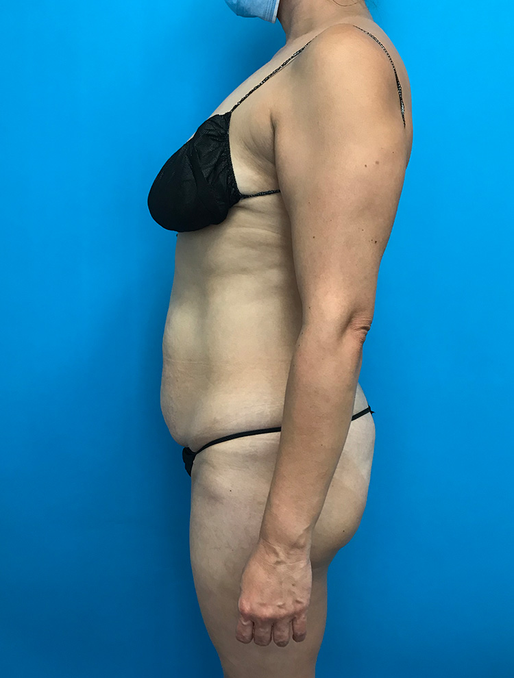 A woman shown from the side after a tummy tuck procedure, wearing black lingerie. The image highlights the abdominal area post-surgery, showing improved contour.