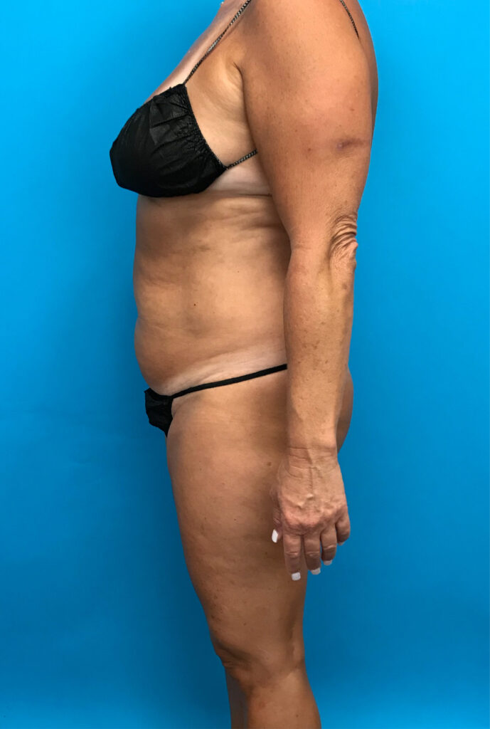 Case TTK-0759 before photo — Dr. Cat, Beverly Hills
