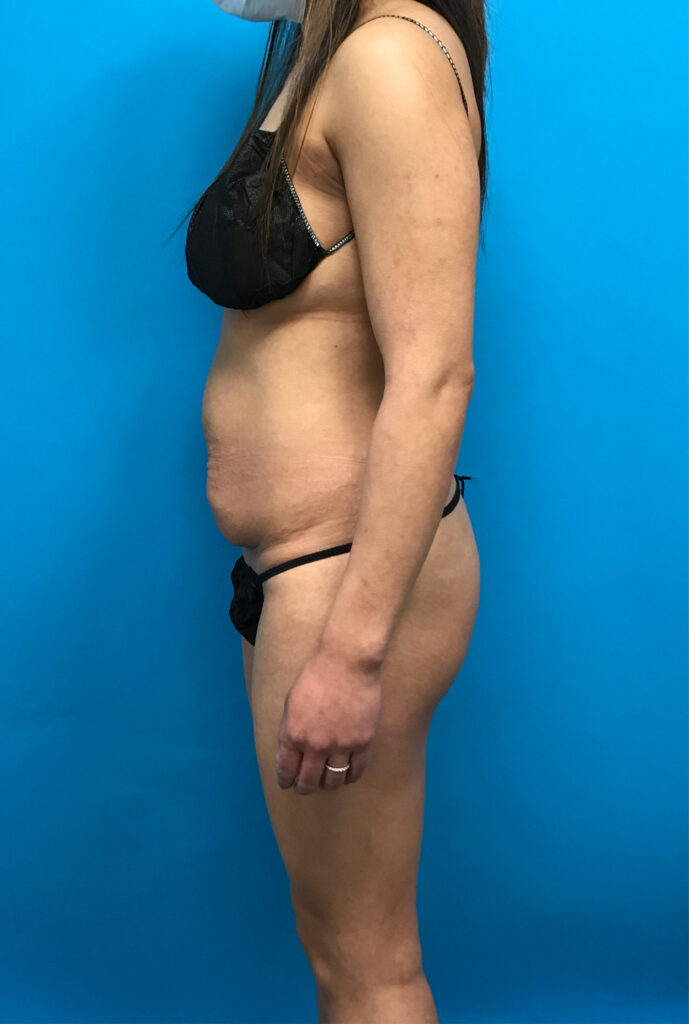 Case TTK-0806 before photo — Dr. Cat, Beverly Hills