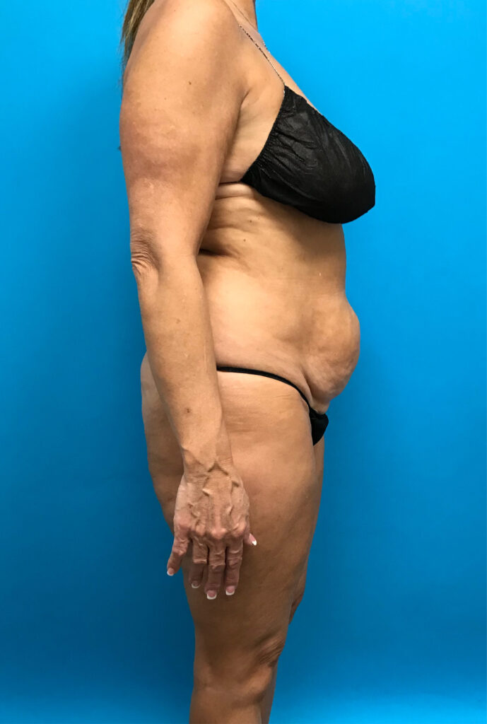 Case TTK-0815 before photo — Dr. Cat, Beverly Hills