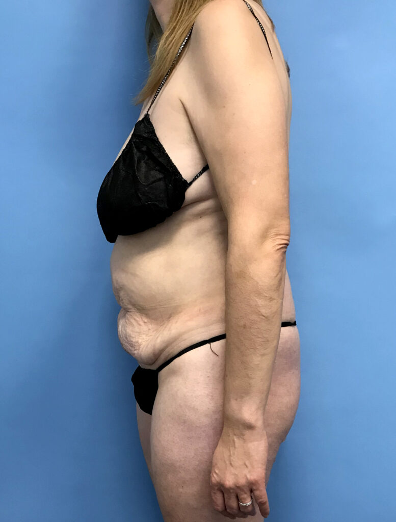 Case TTK-0819 before photo — Dr. Cat, Beverly Hills