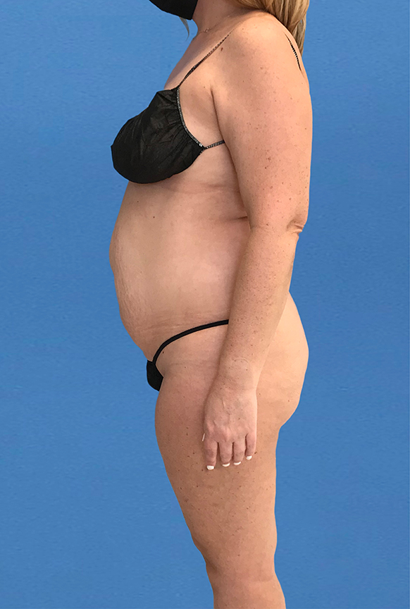 Side view of woman's body before tummy tuck surgery.