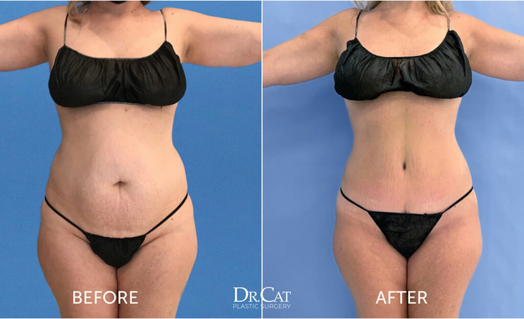 Plastic surgery scar healing guide - Dr. Cat Beverly Hills