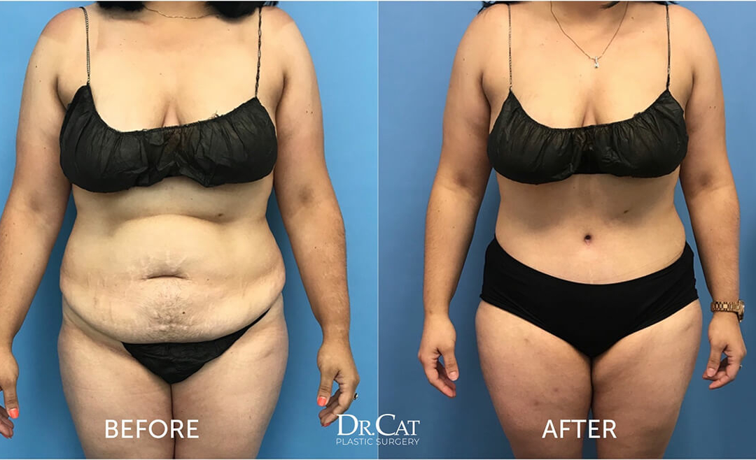 Benefits of tummy tuck surgery - Dr. Cat Beverly Hills