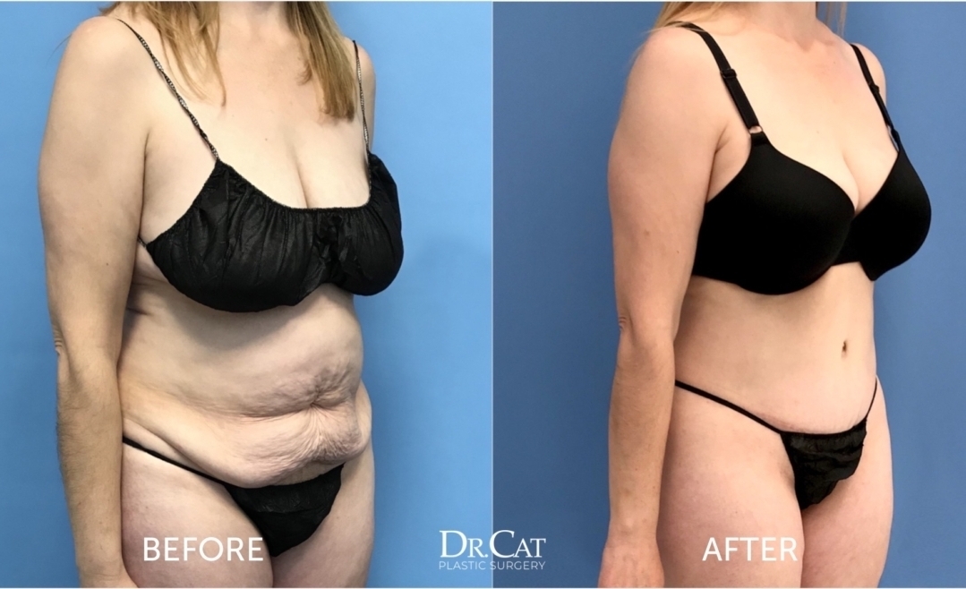 Tummy Tuck patient results - Dr. Cat Beverly Hills
