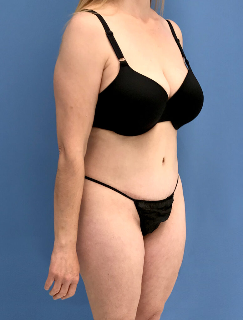 Case TTK-0819 after photo — Dr. Cat, Beverly Hills