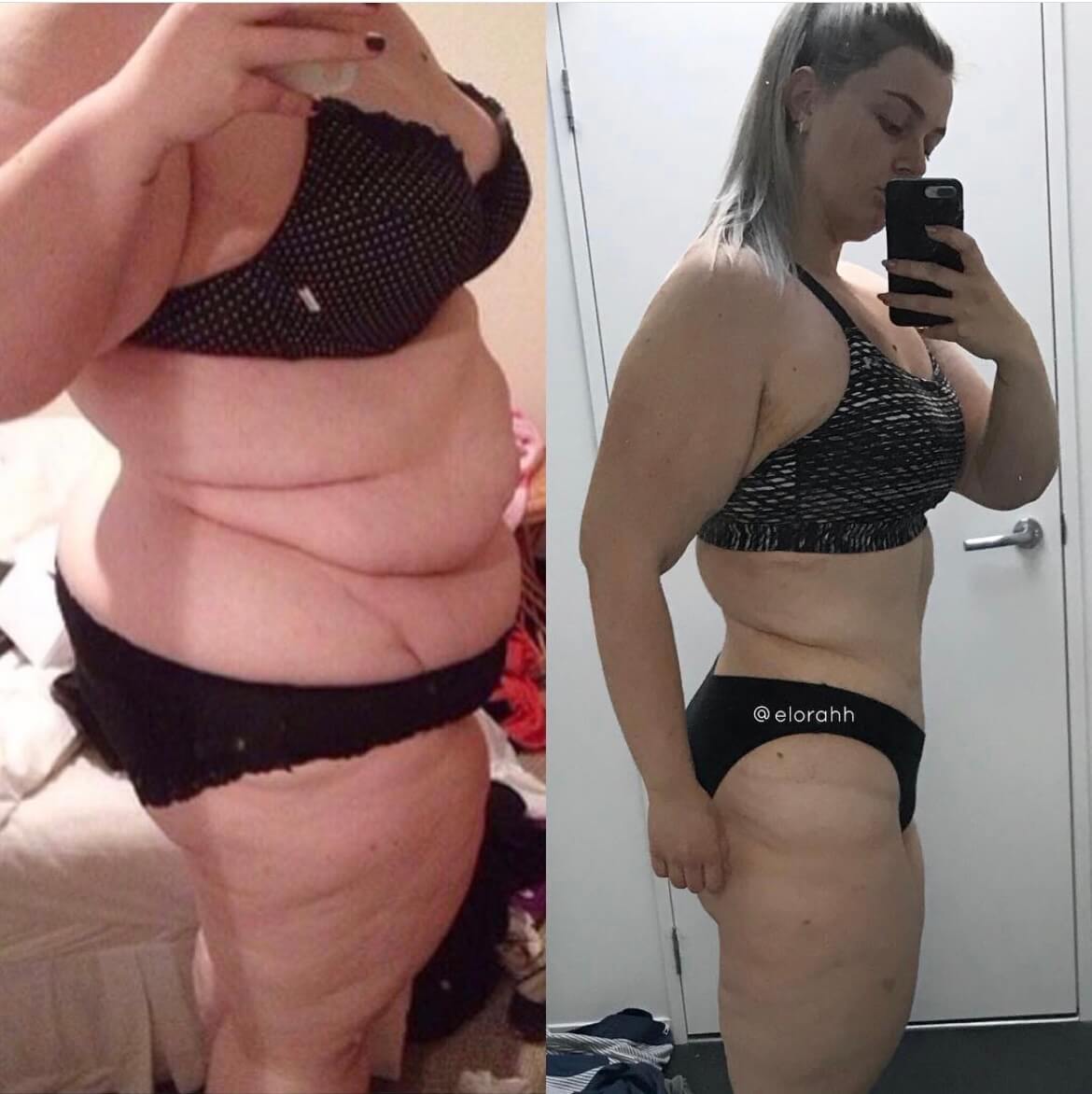 Side-by-side comparison photos of a woman before and after significant weight loss and cosmetic procedures, wearing black underwear.