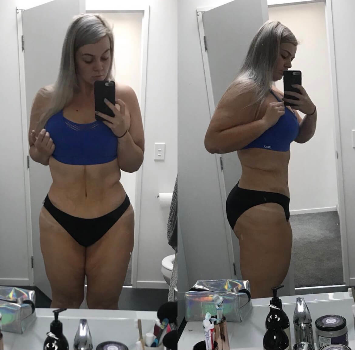 Before and after images showcasing significant body contouring results following a cosmetic procedure, highlighting a slimmer waistline and toned physique.