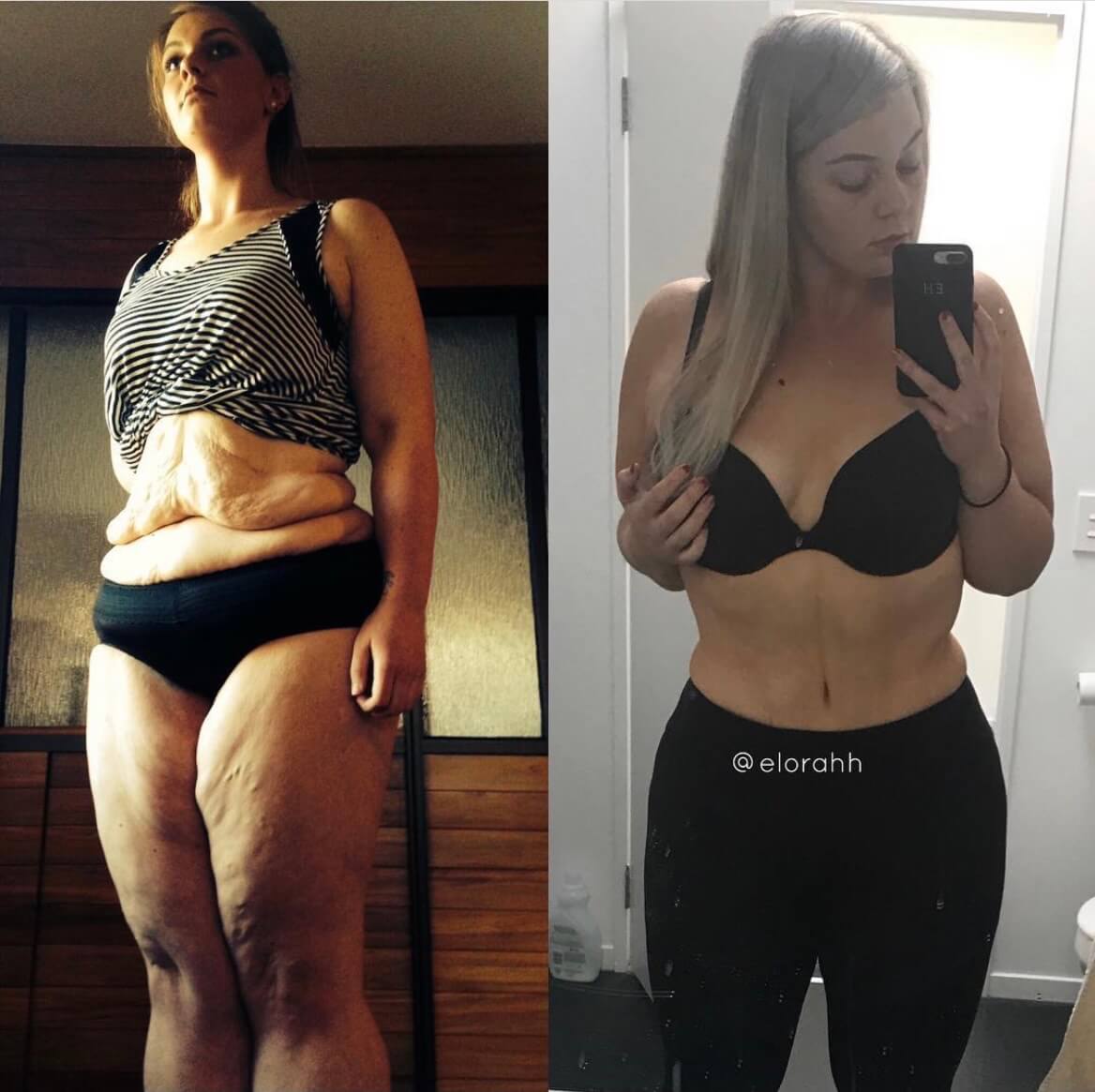 Before and after transformation showcasing a woman's impressive body contouring results.