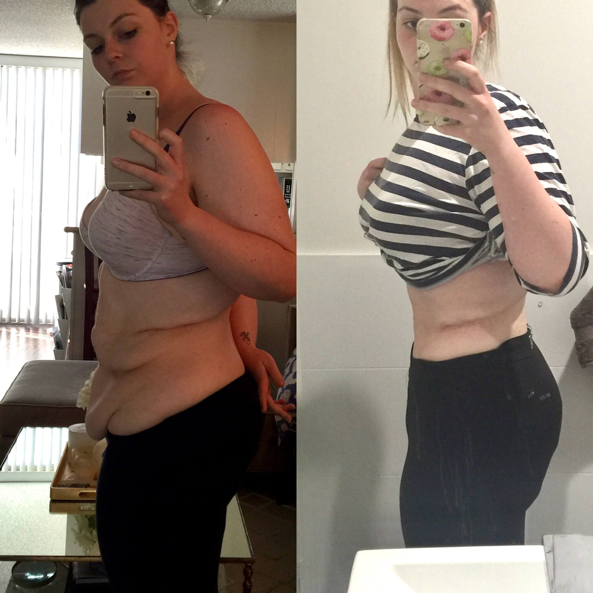 Side-by-side comparison of a woman's body transformation before and after aesthetic surgery.