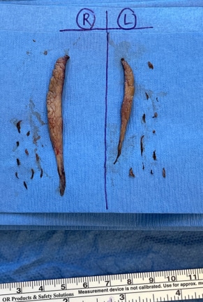 Surgical photo displaying tissue removed during labiaplasty, neatly arranged, measured, and labeled by side.