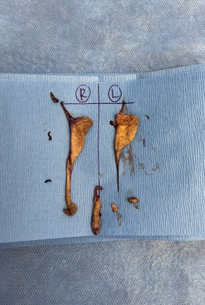 Excised tissue from labiaplasty surgery displayed on surgical drapes, clearly indicating right and left labial segments.