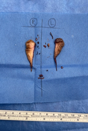 Surgical image showing tissue pieces removed during a cosmetic procedure, neatly organized and labeled on a sterile surgical cloth.