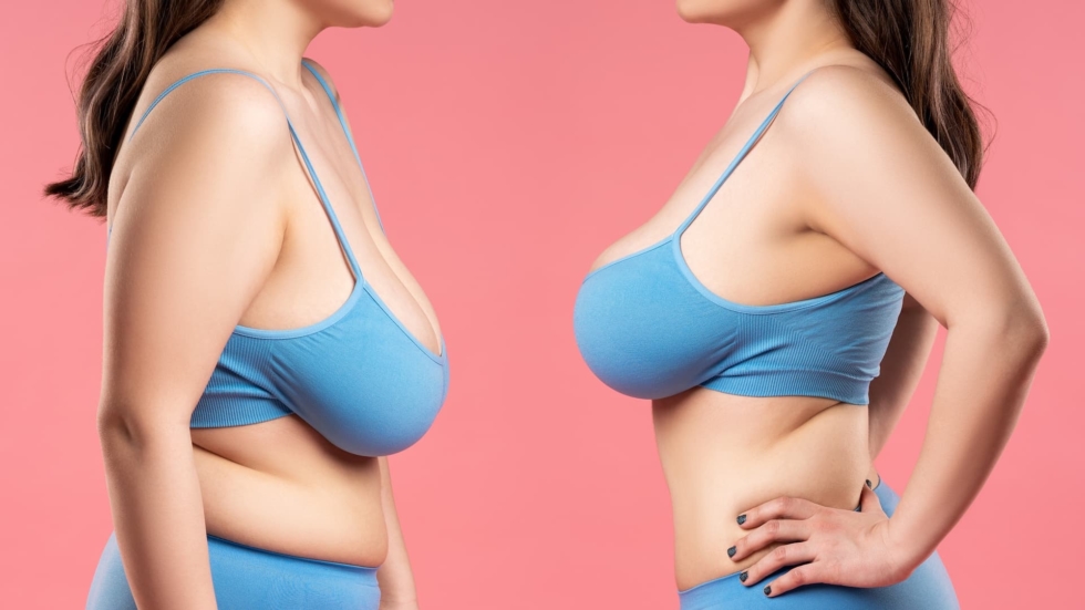 Side-by-side comparison of a woman's upper body before and after a breast lift procedure, showing improved breast shape and position.