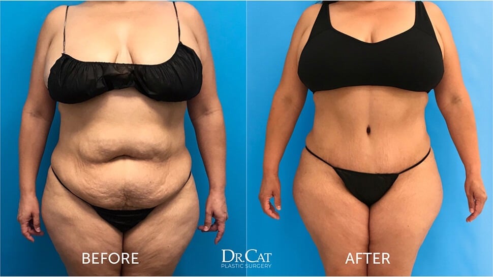 Exercise after tummy tuck guidelines - Dr. Cat Beverly Hills