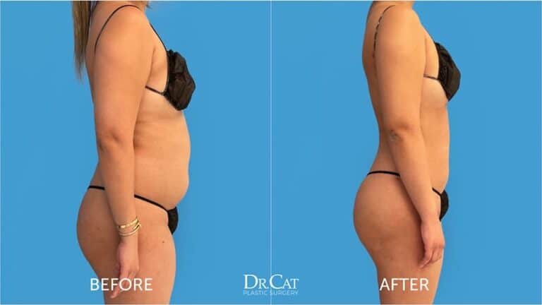 Liposuction patient results - Dr. Cat Beverly Hills