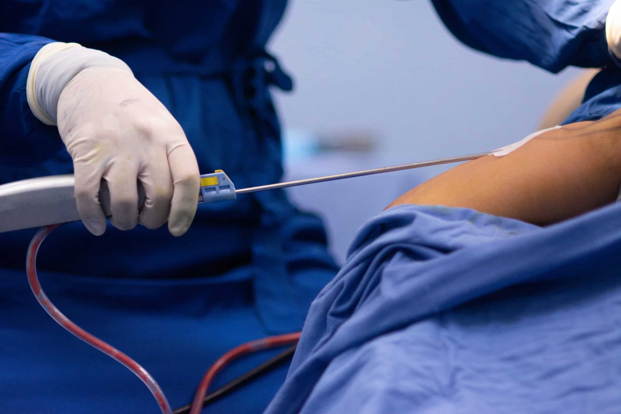 Liposuction side effects