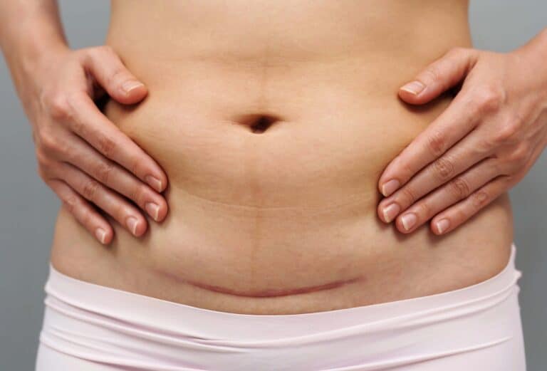 C-section Scar Treatment
