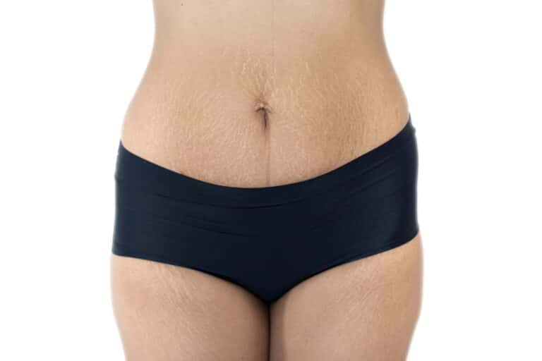 Stretch Marks After Tummy Tuck