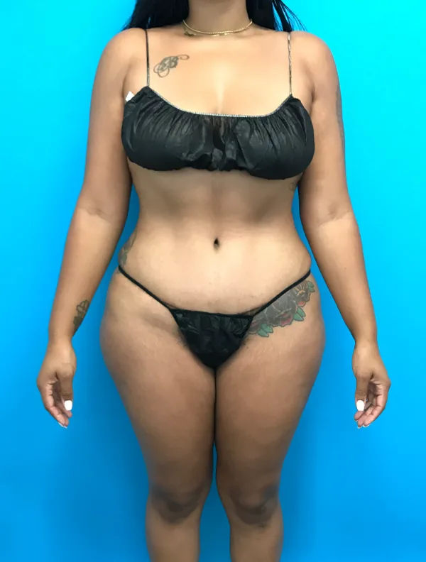 Front view of the same patient after her tummy tuck with Dr. Cat, case TTK-0725