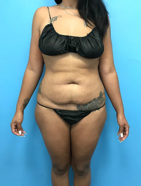 Front view of a patient before her tummy tuck, case TTK-0725