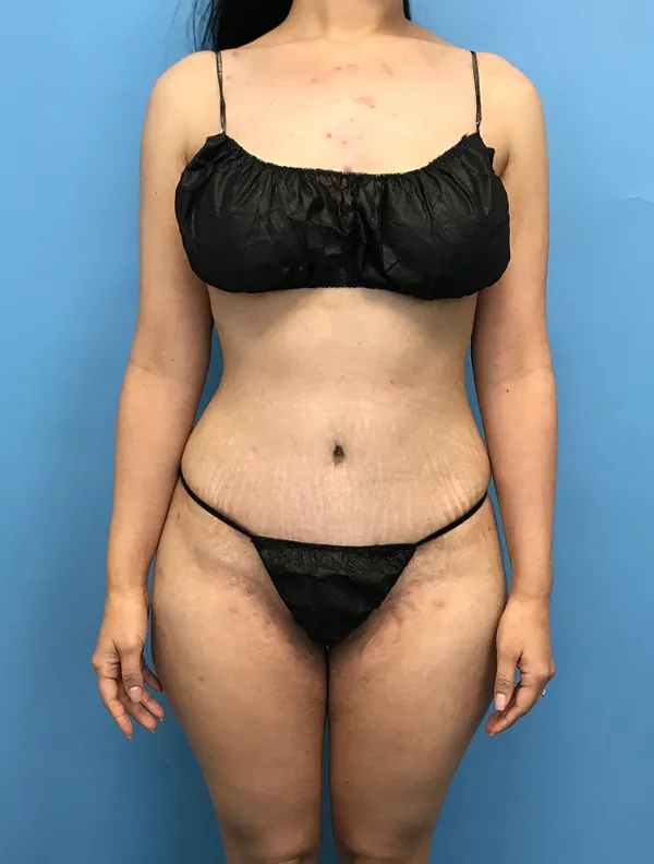 Front view of the same patient after her tummy tuck with Dr. Cat, case TTK-0699