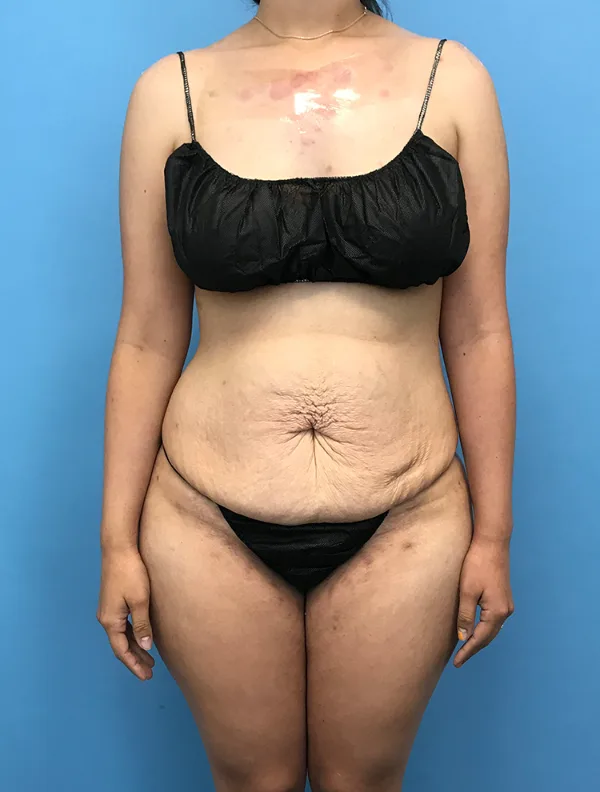 Front view of a patient before her tummy tuck, case TTK-0699