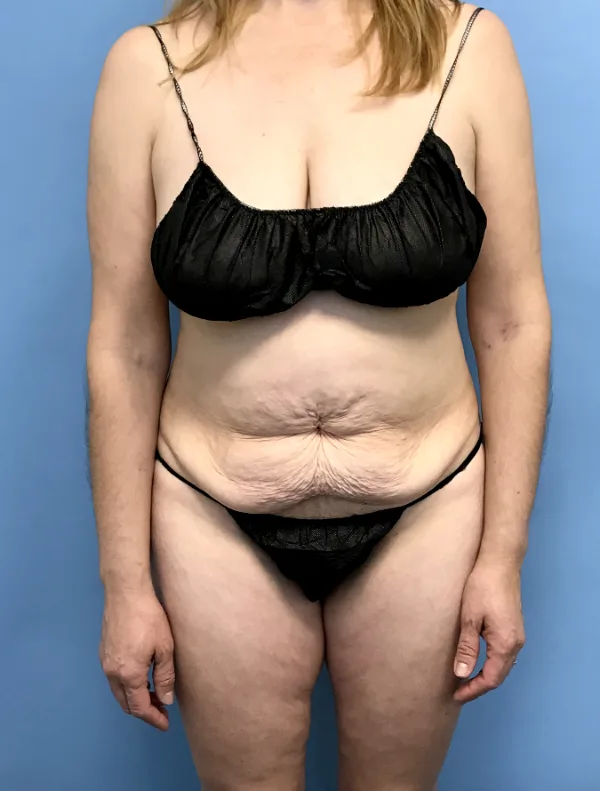Front view of a patient before her tummy tuck, case TTK-0819