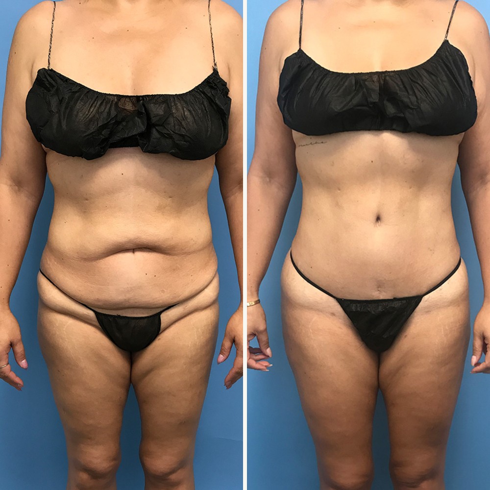 Revision Liposuction in Beverly Hills