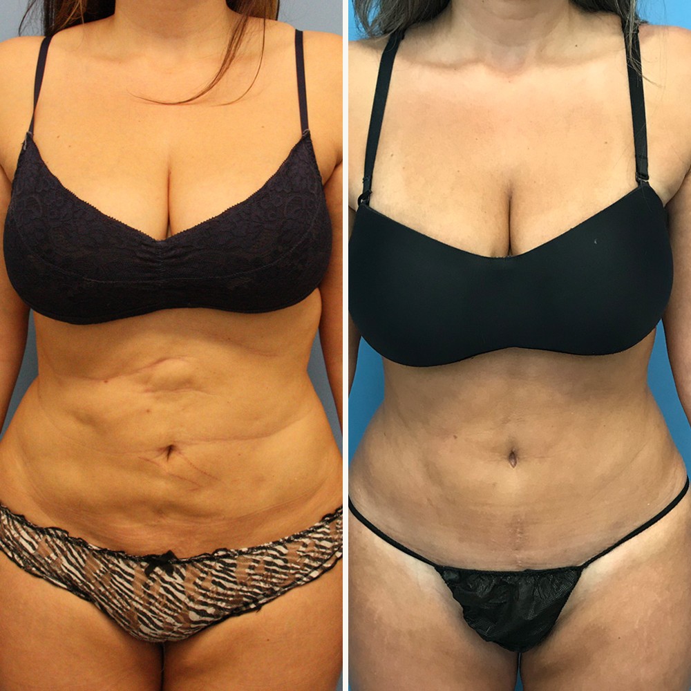 Revision Tummy Tuck in Beverly Hills