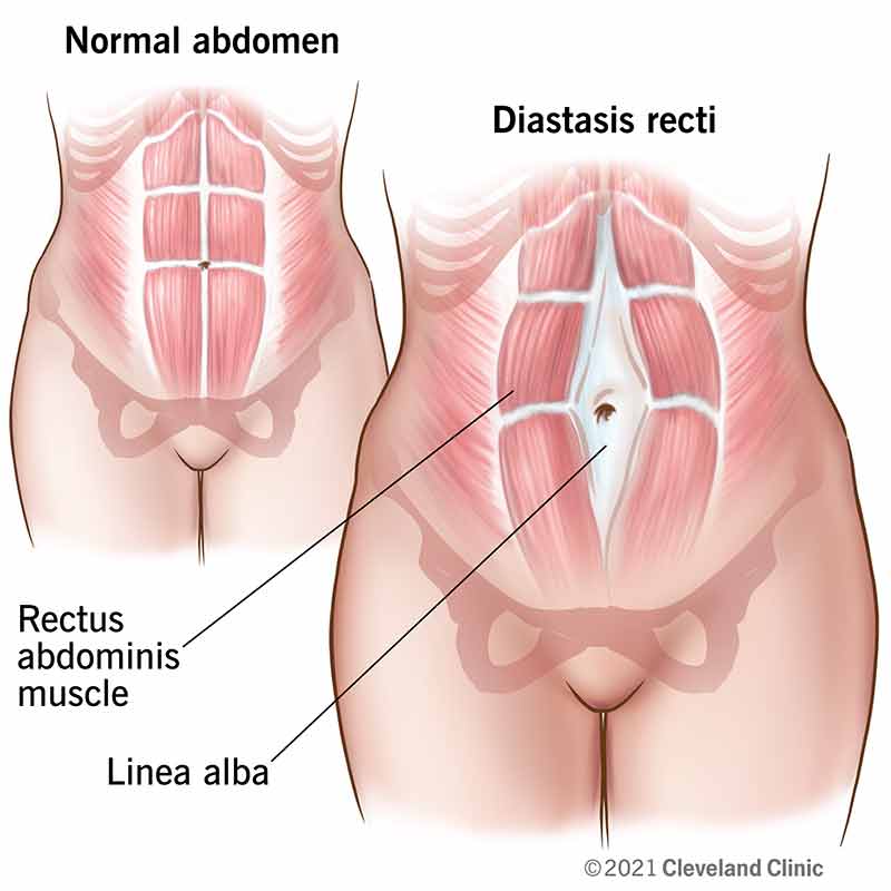 Graphic illustrating abdominal muscle separation characterized by diastasis recti versus that of a normal abdomen