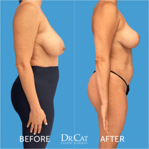 Breast Reduction Surgery Results