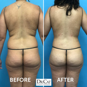 laser lipo before and after back