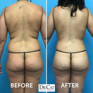 Everything You Need to Know About Laser Liposuction Procedures - Dr. Cat  Begovic