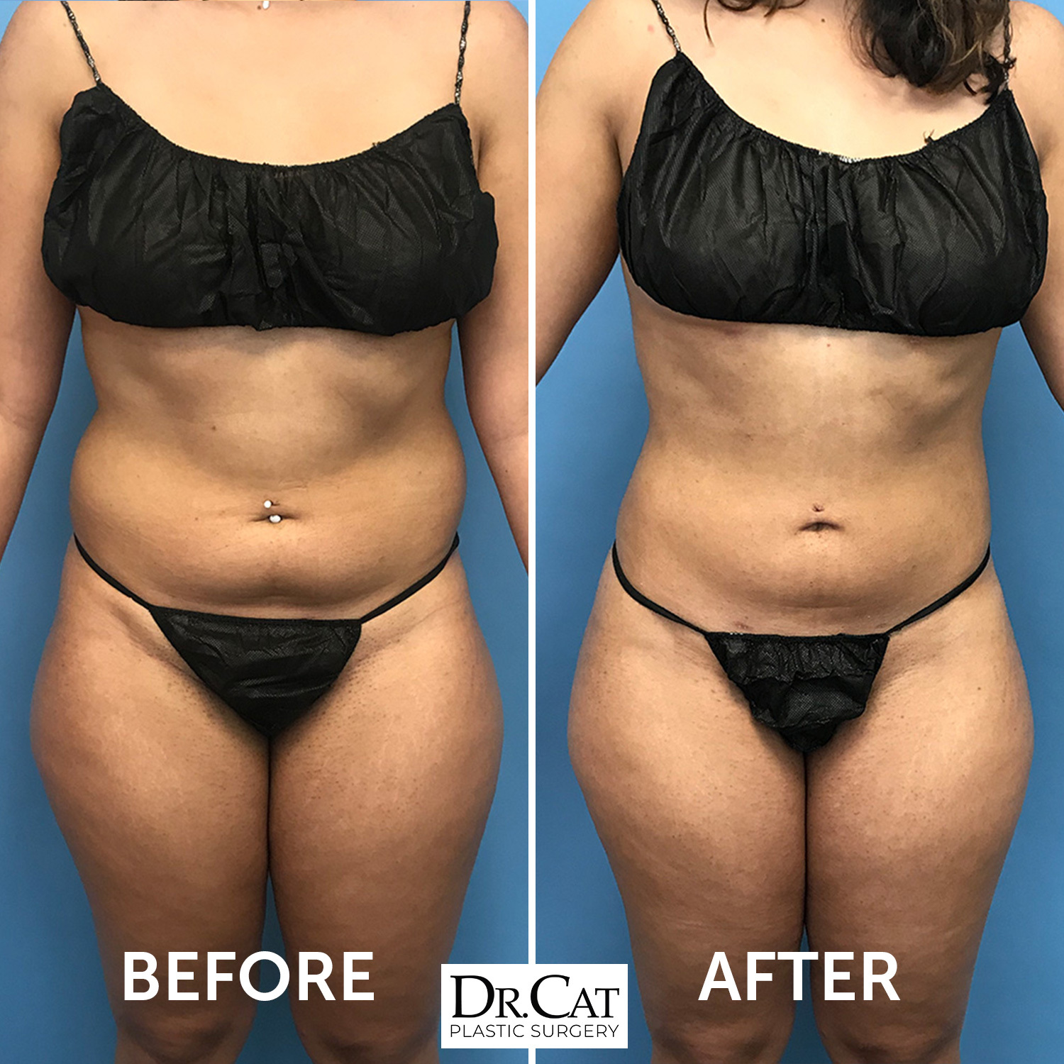 Losing Front Bra Roll Fat With AirSculpt®: How Our Approach Differs