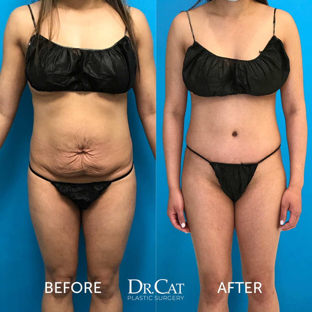 liposuction 360 before and after comparison