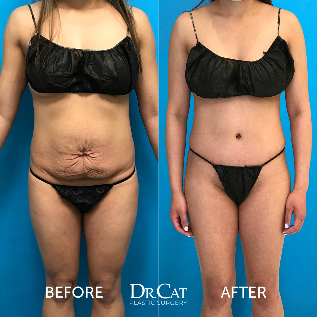 liposuction and tummy tuck difference