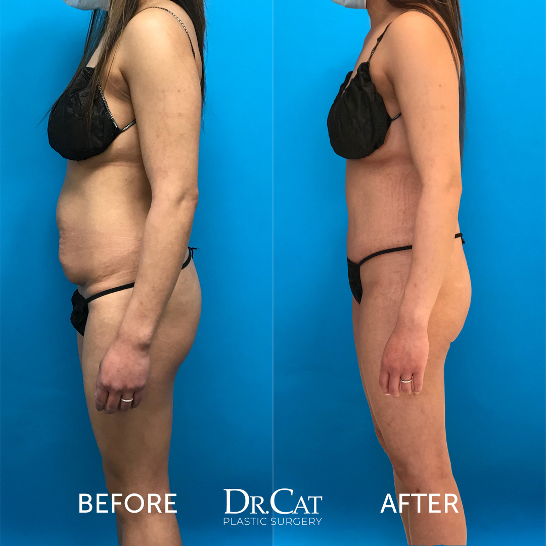 Liposuction Vs Tummy Tuck: Which Is Best for Me? - ICCM