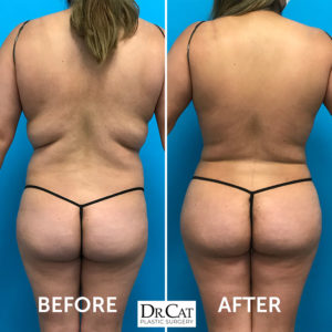 Clinic 360 - Curious about the difference between #Liposuction and # Abdominoplasty? Many people get these two procedures confused. 🌸Liposuction  is a surgical procedure that helps shape and contour body areas by removing