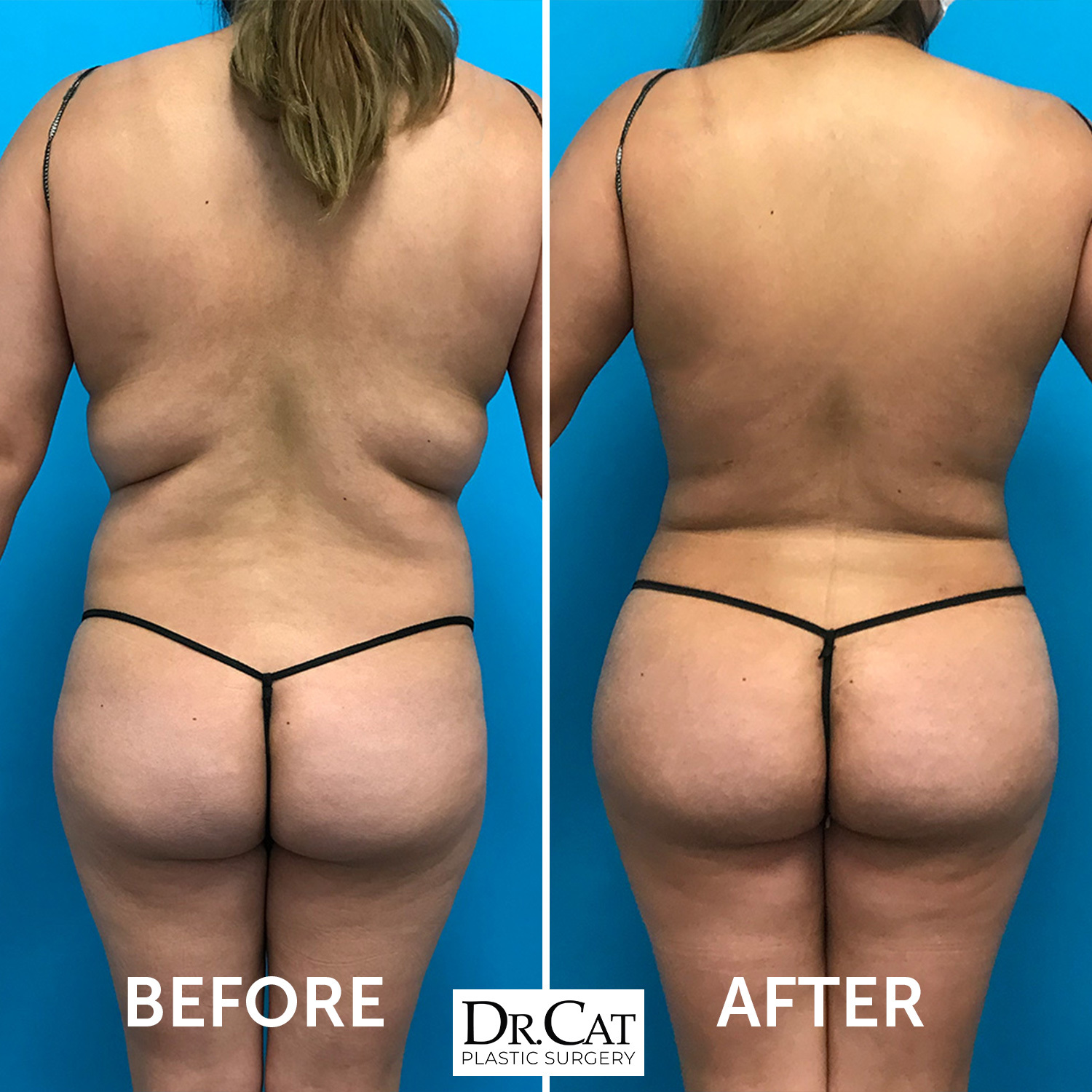Everything You Need to Know About Laser Liposuction Procedures - Dr. Cat  Begovic