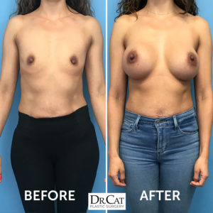 mommy makeover breast augmentation before and after