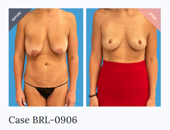 Barrett Beverly Hills, Our patient was concerned of her saggy breast with  lack of upper pole fullness so we performed a breast augmentation and a  lollipop lift