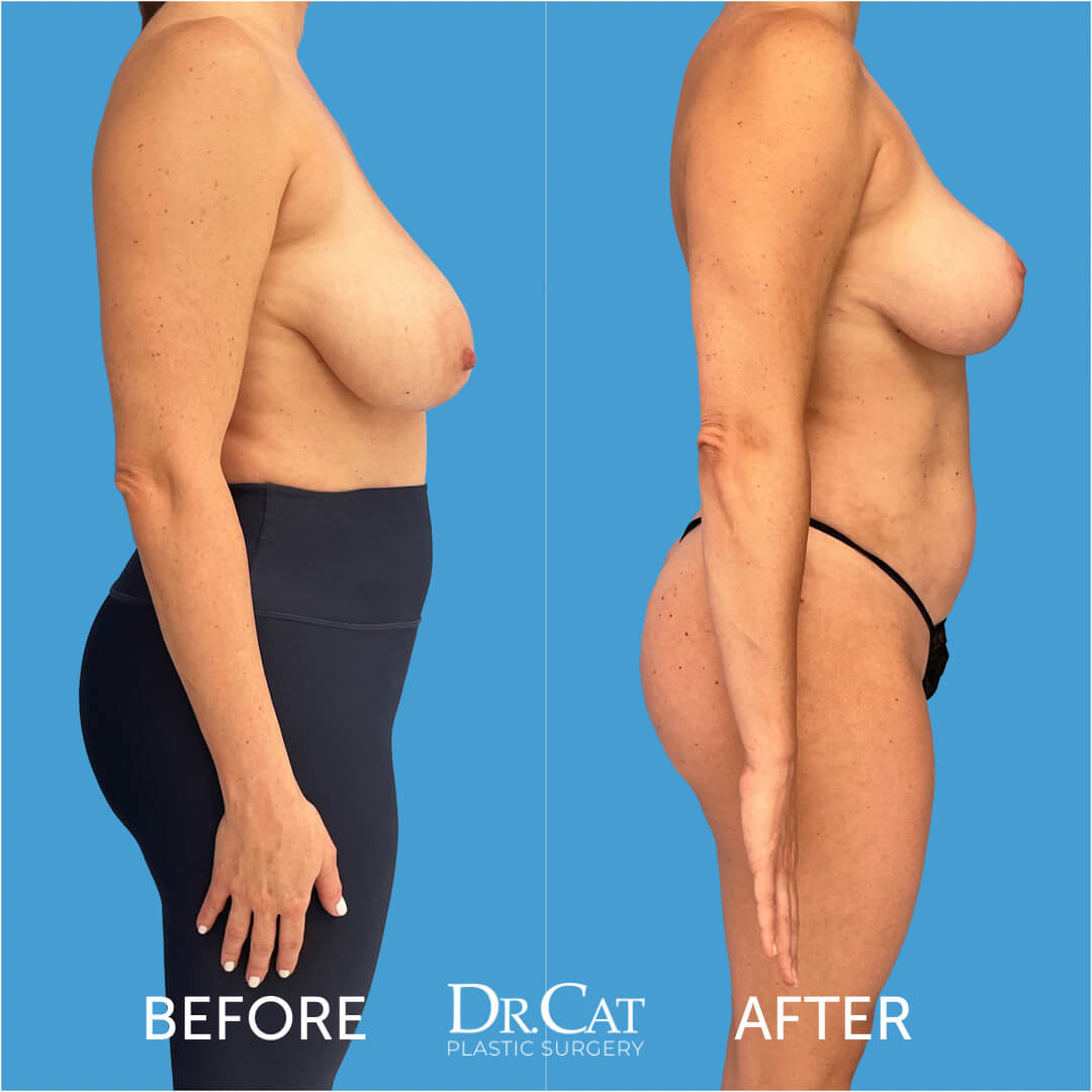Breast reduction
