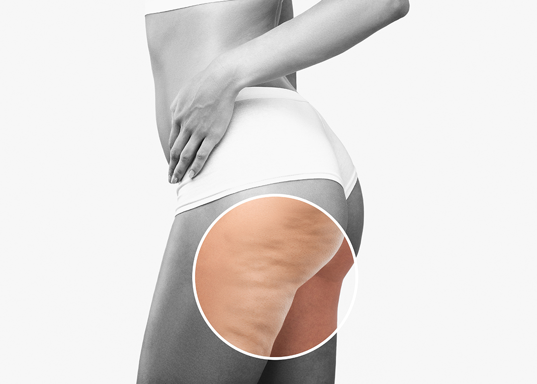 How to Beat Cellulite: The Complete Treatment Guide