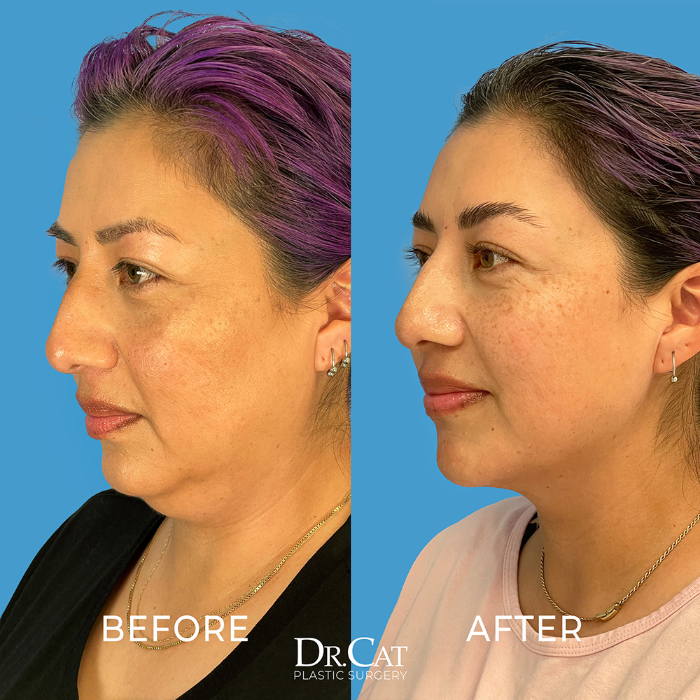 Buccal fat removal before and after showing slimmer facial contour